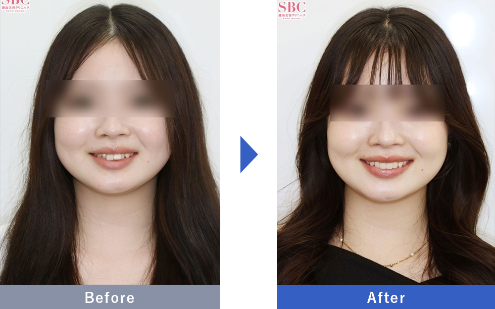 ダイヤモンドクラン(ジルコニア)の症例写真 Before After