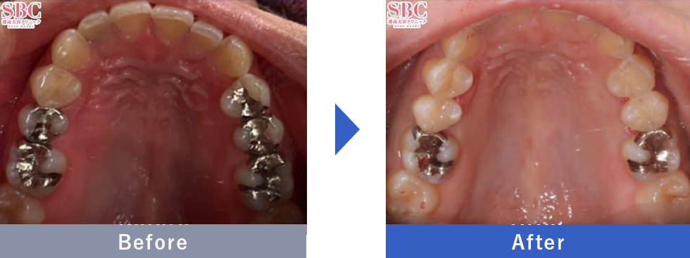 セラミックインレーの症例写真 Before After