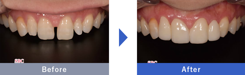 NEOエナメルの症例写真 Before After