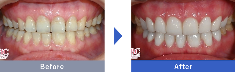ダイヤモンドオーダーセラミック(オーダーメイドプラン付)の症例写真 Before After