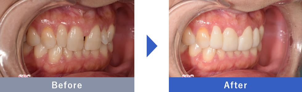 ダイヤモンドベニアの症例写真 Before After