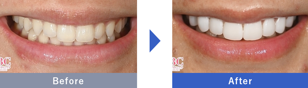 ダイヤモンドベニアの症例写真 Before After