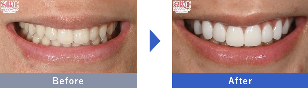 ダイヤモンドベニアの症例写真 Before After