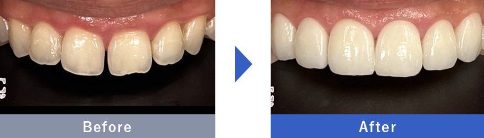 ダイヤモンドベニアの症例写真 Before After