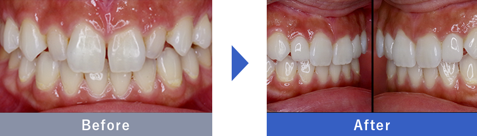NEOエナメルの症例写真 Before After