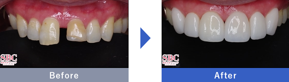 NEOエナメルの症例写真 Before After