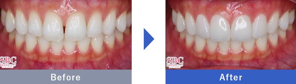 NEOエナメルの症例写真 Before After