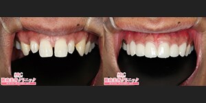 浅井医師 セラミック 症例写真09
