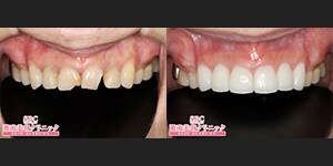 浅井医師 セラミック 症例写真08