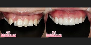 浅井医師 セラミック 症例写真07