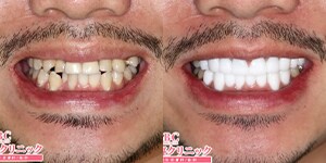 浅井医師 セラミック 症例写真03