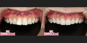 浅井医師 セラミック 症例写真01