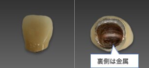 保険の歯