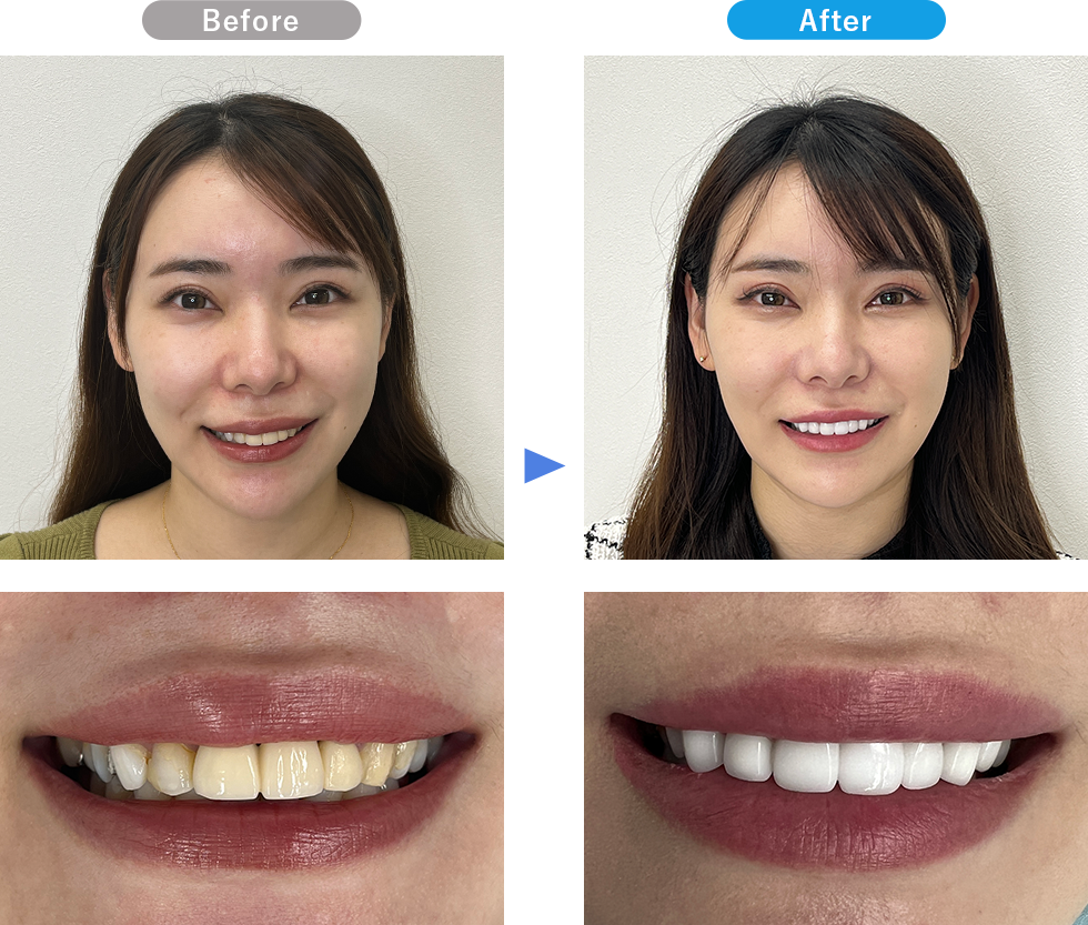プレミアムダイヤモンドセラミックの症例写真01 Before After