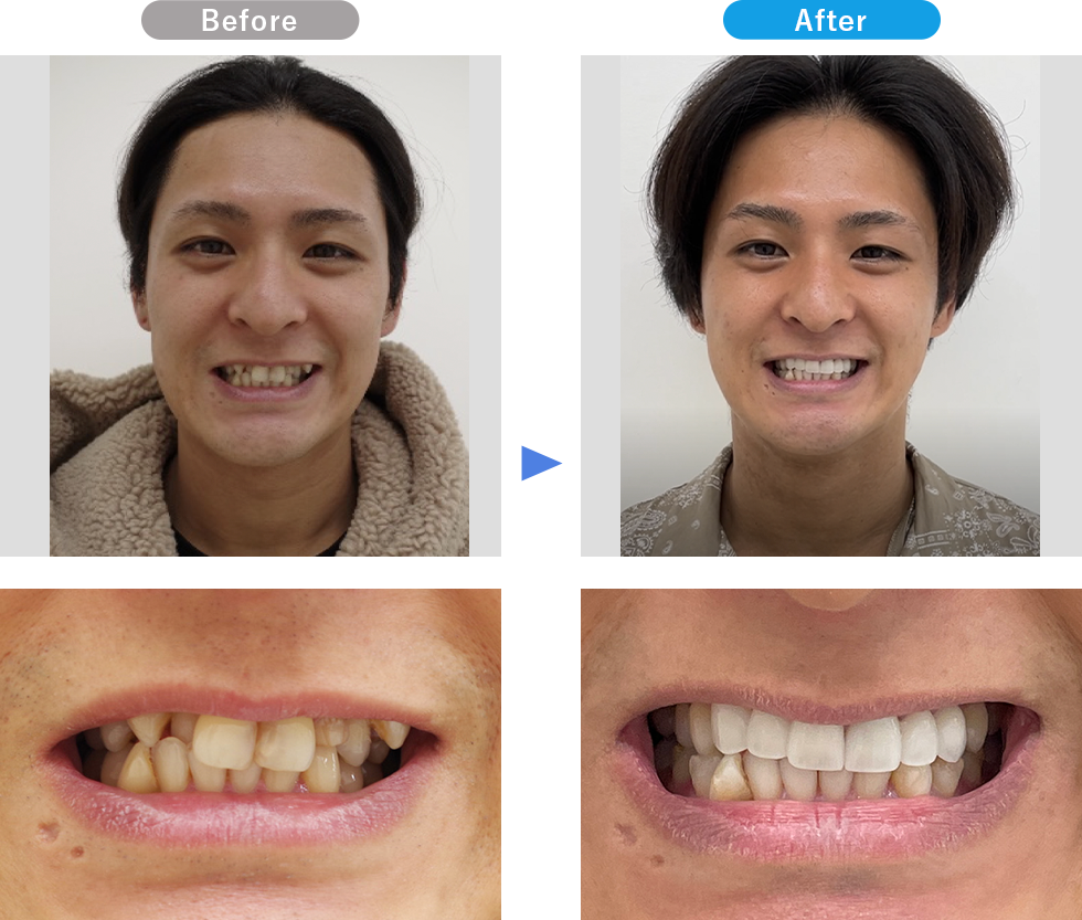 ダイヤモンドオーダーセラミックの症例写真01 Before After