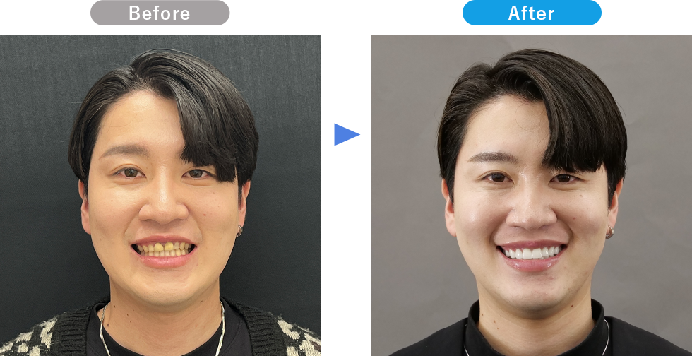 プレミアムダイヤモンドセラミックの症例写真03 Before After