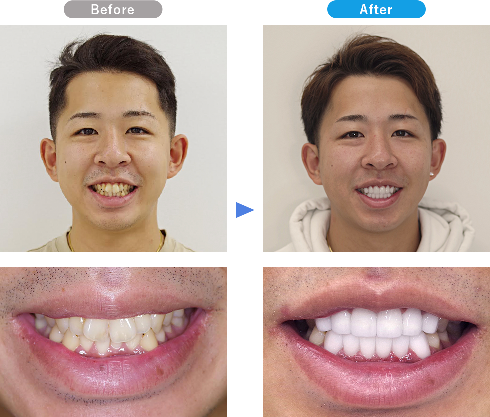 ダイヤモンドオーダーセラミックの症例写真02 Before After