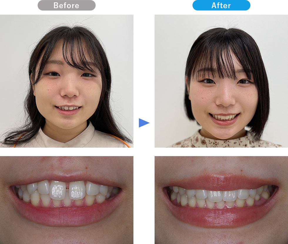 マウスピースの症例写真02 Before After