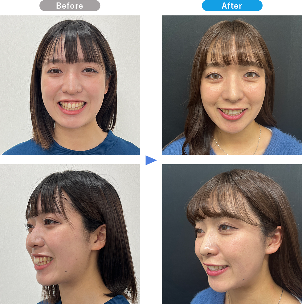 マウスピースの症例写真01 Before After