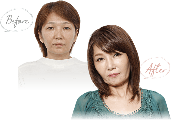 若返り施術によるビフォーアフター