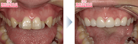 セラミック治療症例写真