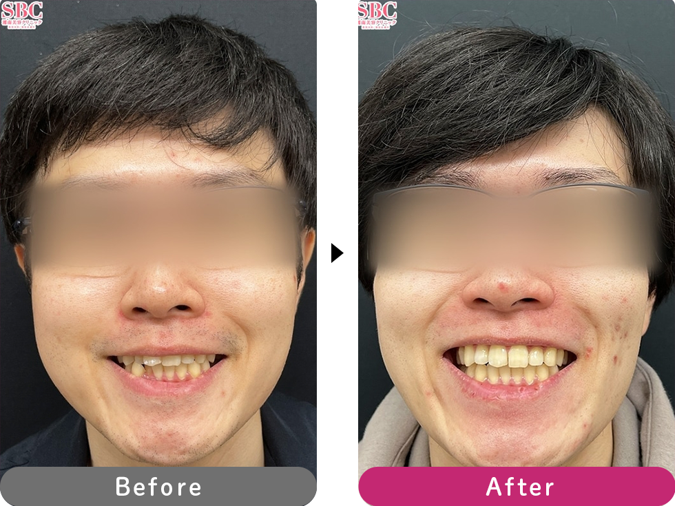 インビザラインモデレートの症例写真