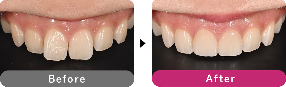 ダイヤモンドオーダーセラミックの症例写真