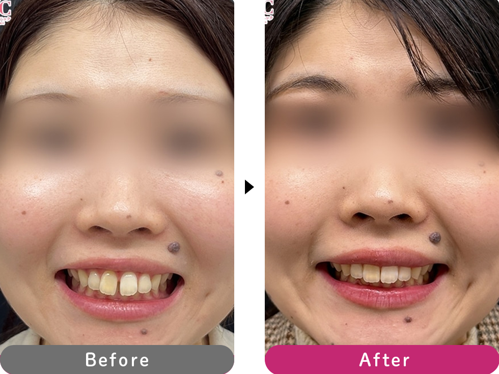 インビザラインモデレートの症例写真