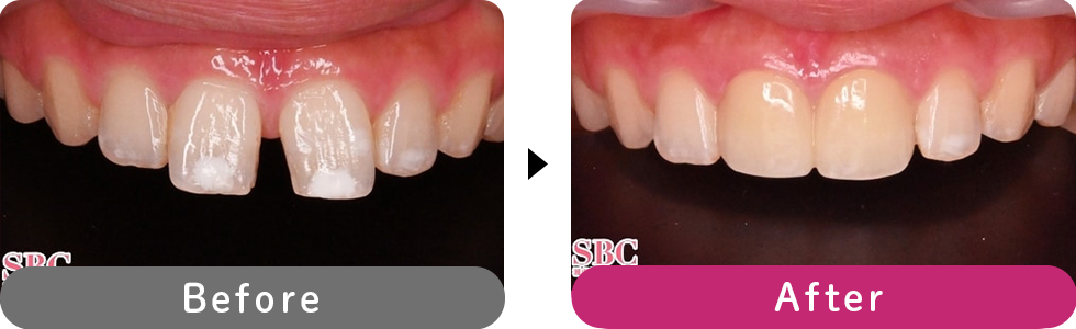 プレミアムダイヤモンドセラミックの症例写真