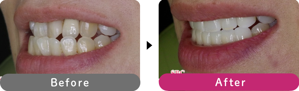 プレミアムダイヤモンドセラミックの症例写真