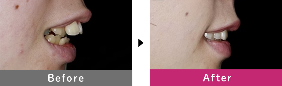 インビザラインフル