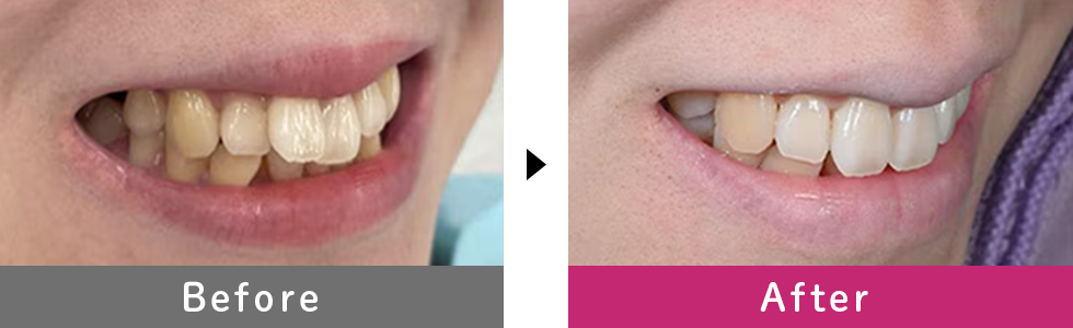 湘南マウスピース