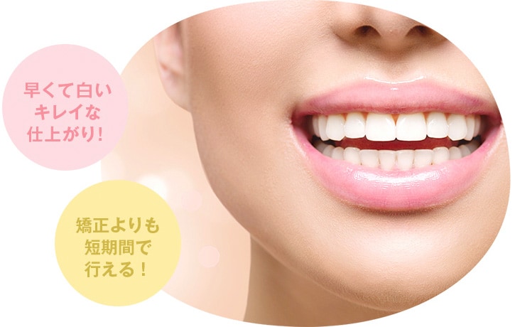 早くて白いキレイな仕上がり!矯正よりも短期間で行える!
