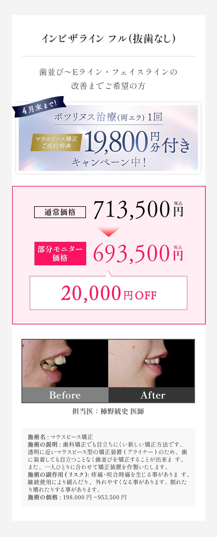 インビザラインフル 料金