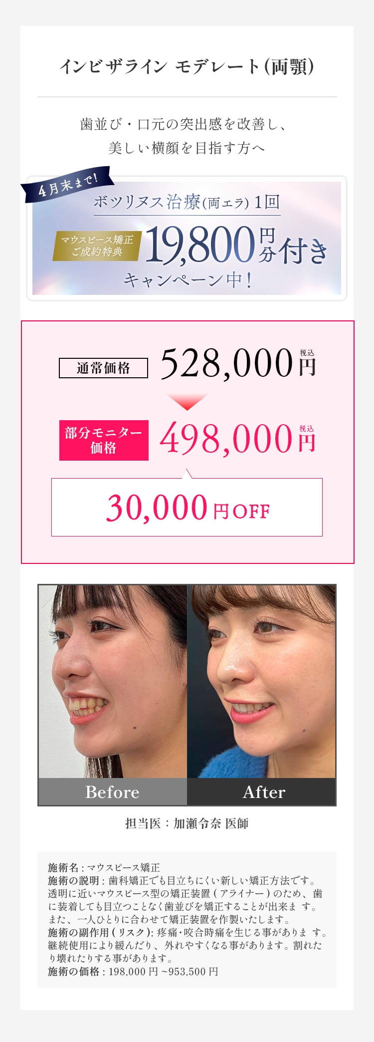 インビザラインモデレート 料金