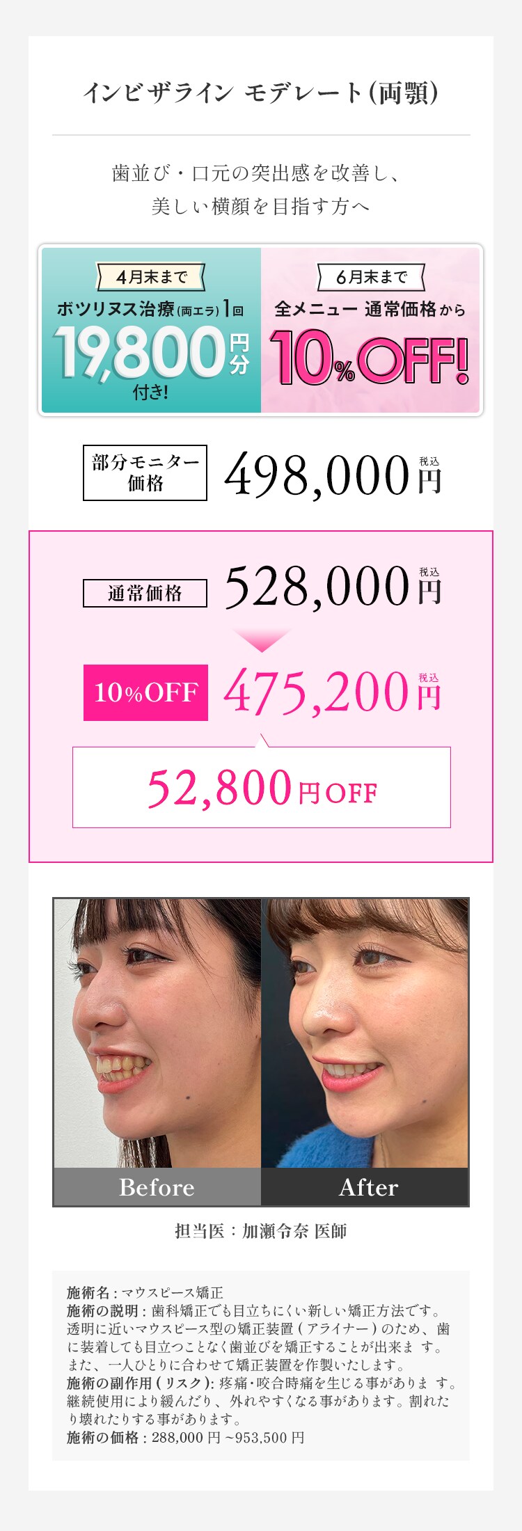 インビザラインモデレート 料金