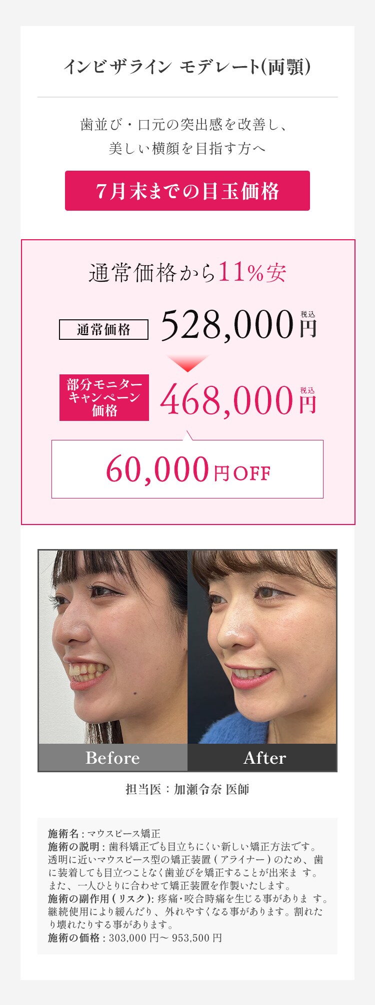 インビザラインモデレート 料金