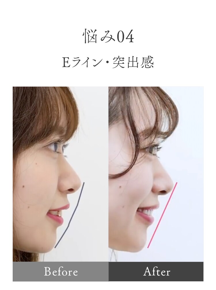Eライン