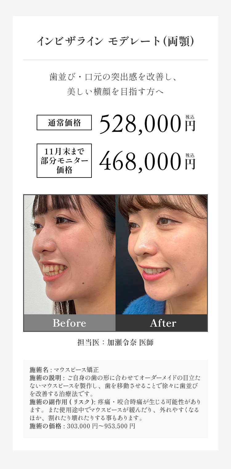 インビザラインモデレート 料金