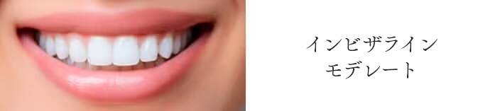 インビザライン モデレート