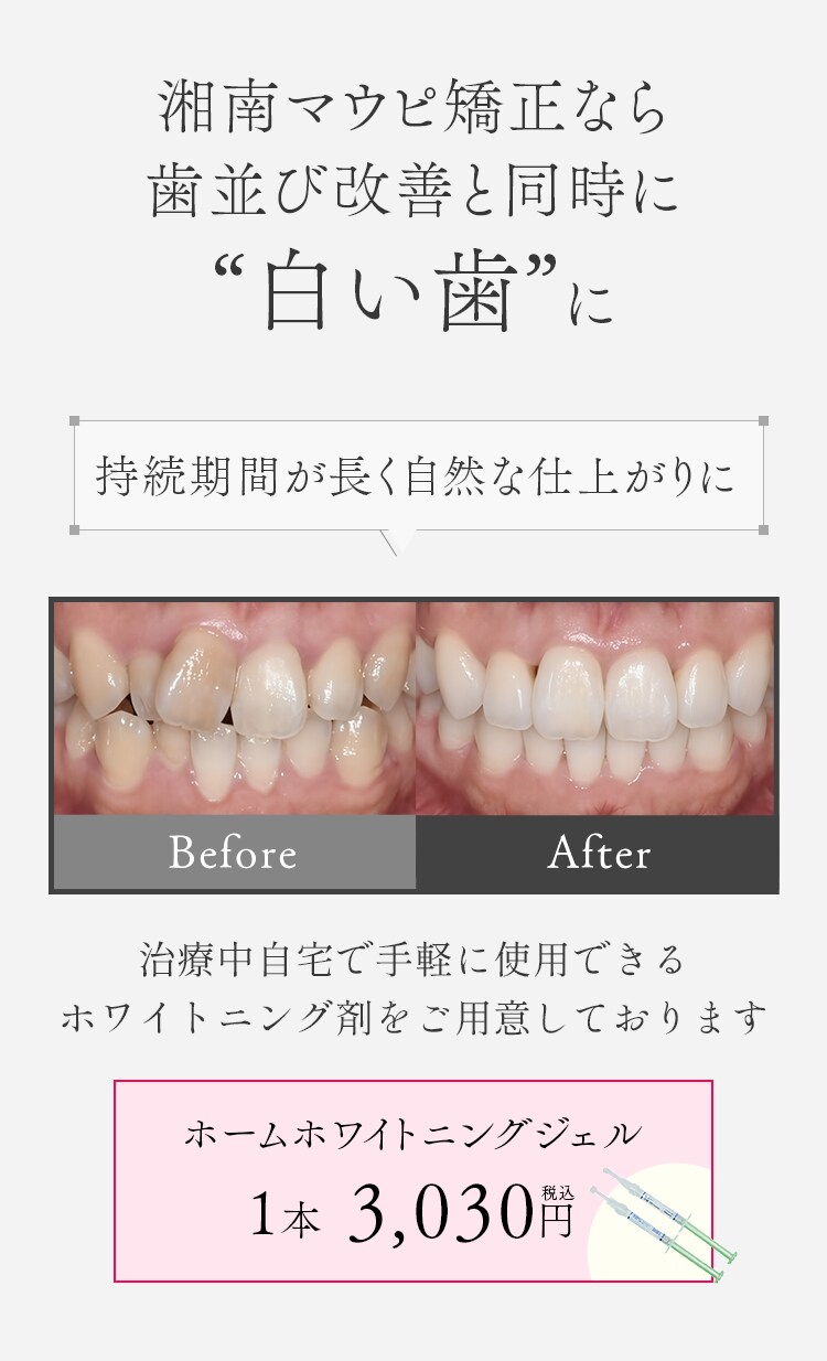 歯並び改善と同時に白い歯に
