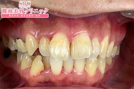 before