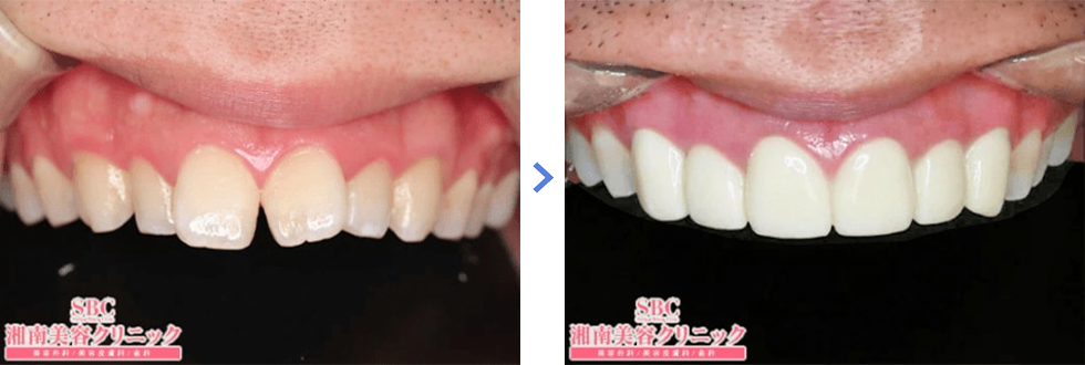 フルジルコニアセラミック症例写真01