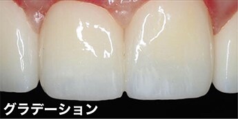 ダイヤモンドクラウン（ジルコニア）