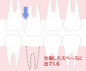対合歯の挺出とは