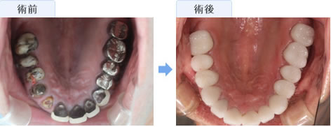 セラミックによる虫歯治療 セラミック矯正 湘南美容歯科