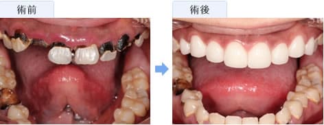セラミックによる虫歯治療 セラミッククラウン 湘南美容歯科