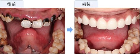 セラミックによる虫歯治療 セラミック矯正 湘南美容歯科