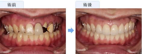 セラミックによる虫歯治療 セラミック矯正 湘南美容歯科