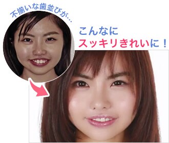 セラミック治療をオススメする理由 セラミッククラウン 湘南美容歯科